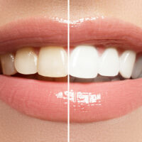 5 reasons at-home teeth whitening isn&#8217;t ideal always