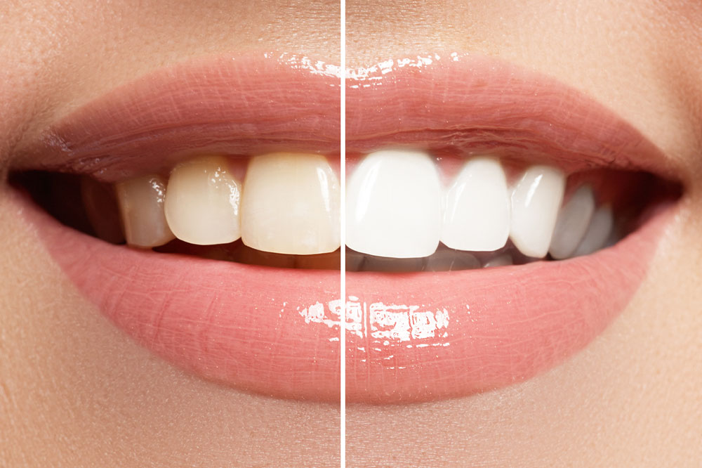 5 reasons at-home teeth whitening isn&#8217;t ideal always